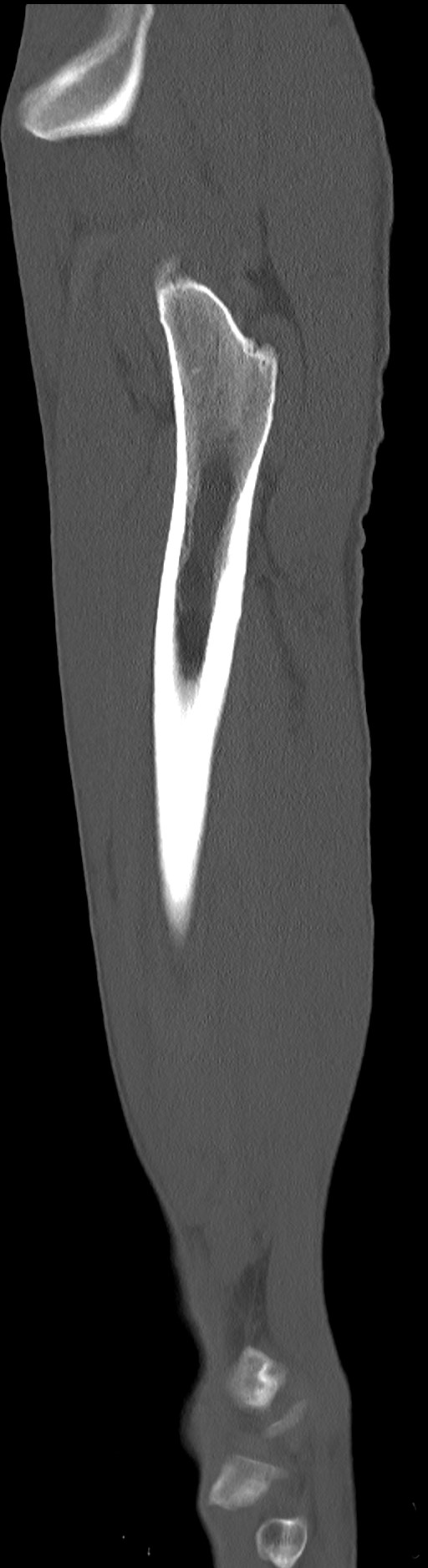 Chronic osteomyelitis (with sequestrum) (Radiopaedia 74813-85822 C 22).jpg