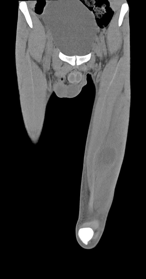 Chronic osteomyelitis (with sequestrum) (Radiopaedia 74813-85822 E 10).jpg