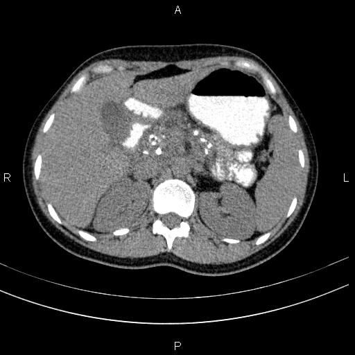 Chronic pancreatitis (Radiopaedia 64576-73450 Axial non-contrast 42).jpg