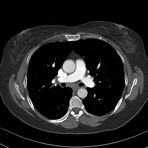 Chronic pulmonary embolus (Radiopaedia 39129-41341 Axial C+ CTPA 47).png