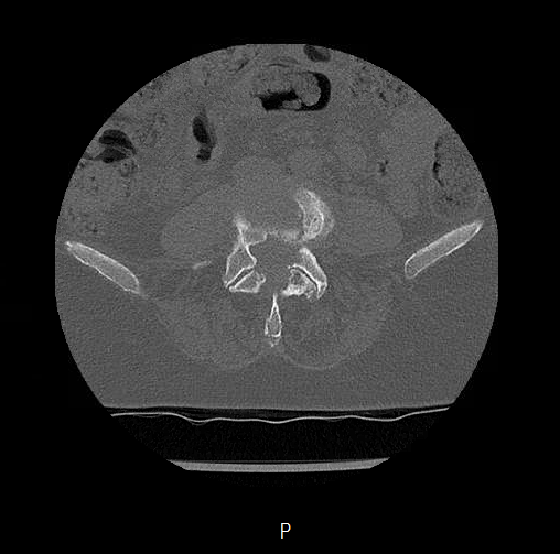 Chronic spinal hematoma with cauda equina syndrome (Radiopaedia 75745-88197 Axial bone window 45).png