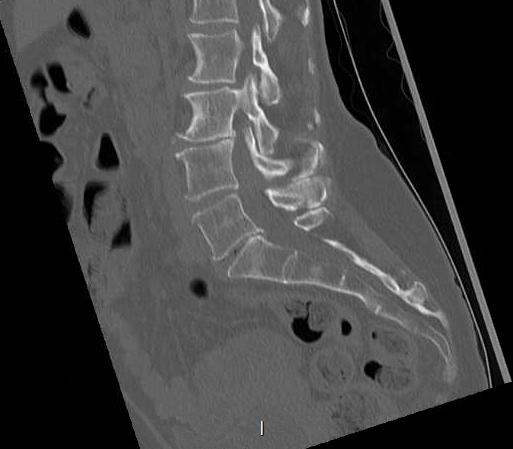 File:Chronic spinal hematoma with cauda equina syndrome (Radiopaedia 75745-88197 Sagittal bone window 13).png