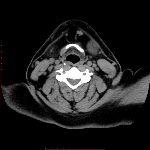 Chronic submandibular sialolithiasis (Radiopaedia 69817-79814 Axial non-contrast 151).jpg