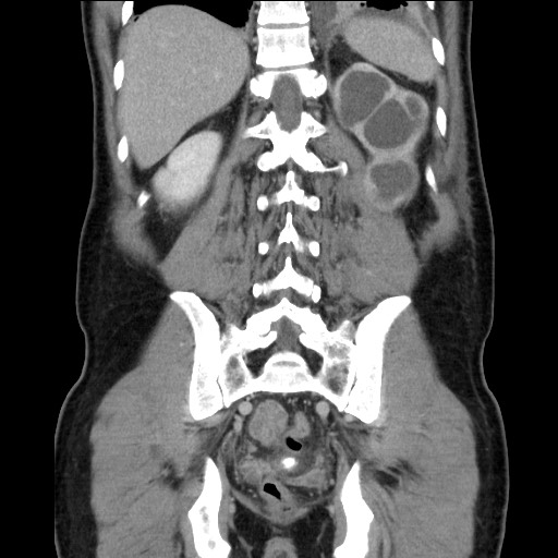 Chronic ureteropelvic junction obstruction (Radiopaedia 78365-90996 B 77).jpg