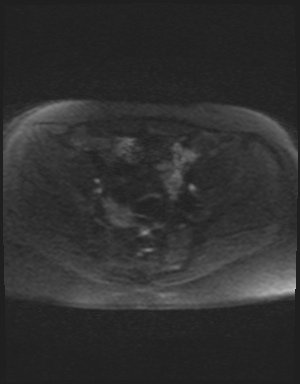 Class II Mullerian duct anomaly- unicornuate uterus with rudimentary horn and non-communicating cavity (Radiopaedia 39441-41755 Axial DWI 44).jpg