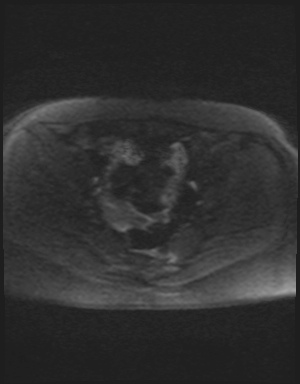 Class II Mullerian duct anomaly- unicornuate uterus with rudimentary horn and non-communicating cavity (Radiopaedia 39441-41755 Axial DWI 45).jpg