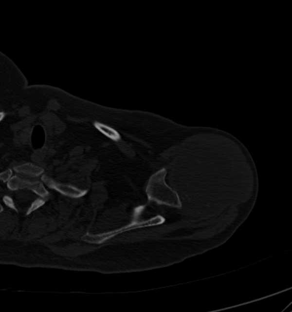 Clear cell chondrosarcoma - humerus (Radiopaedia 63104-71612 Axial bone window 24).jpg