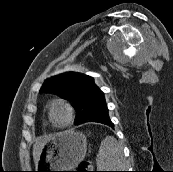 Clear cell chondrosarcoma - humerus (Radiopaedia 63104-71612 D 35).jpg