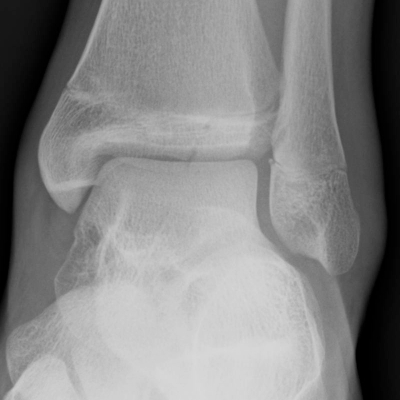 File:Cleft epiphysis - tibia (Radiopaedia 24381-24671 Coned frontal 1).jpg