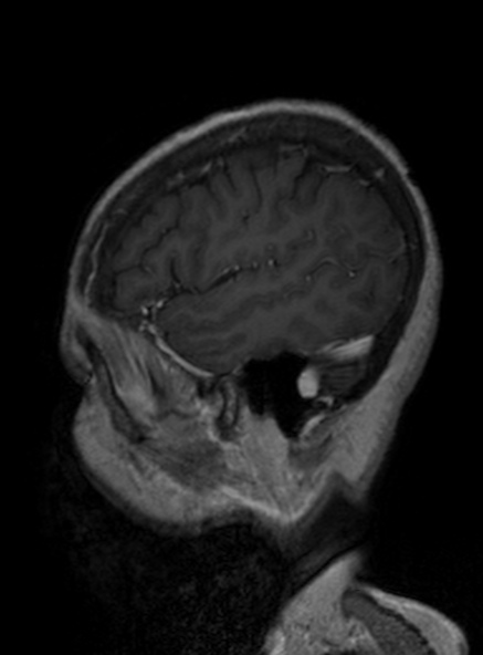 Clival meningioma (Radiopaedia 53278-59248 Sagittal T1 C+ 349).jpg
