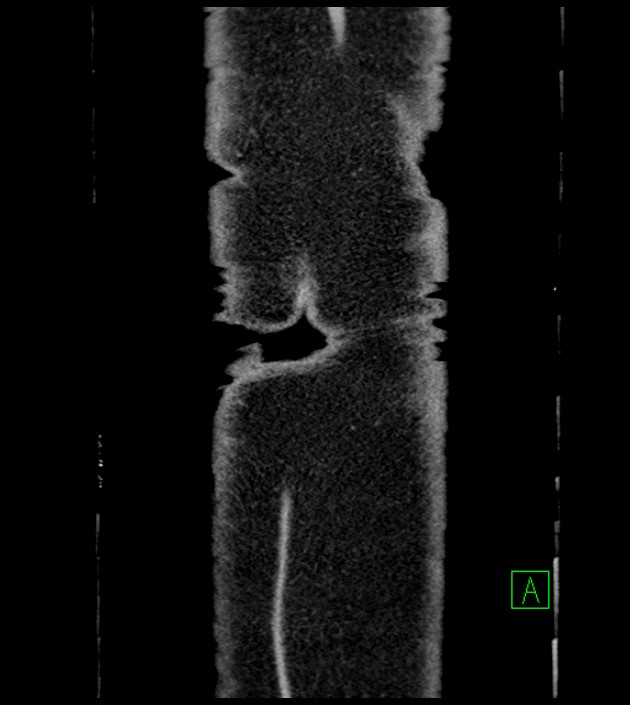 Closed-loop small bowel obstruction-internal hernia (Radiopaedia 78439-91096 Coronal non-contrast 106).jpg