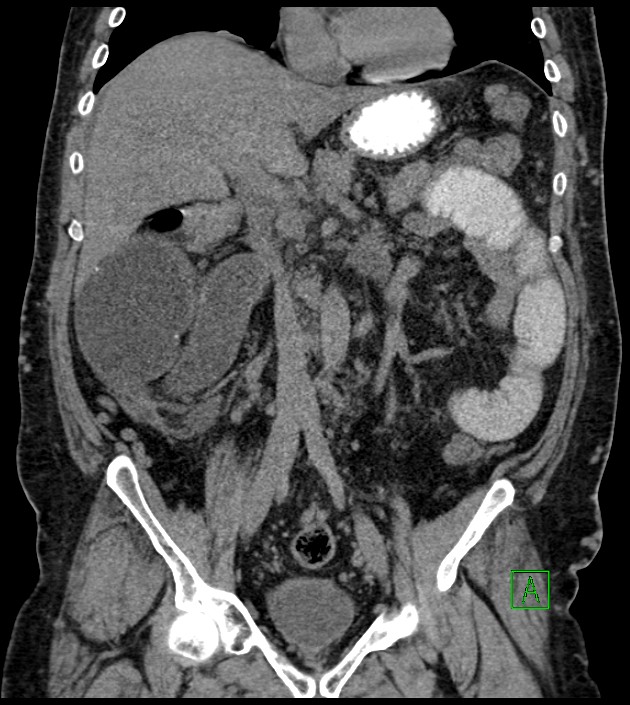 Closed-loop small bowel obstruction-internal hernia (Radiopaedia 78439-91096 Coronal non-contrast 52).jpg