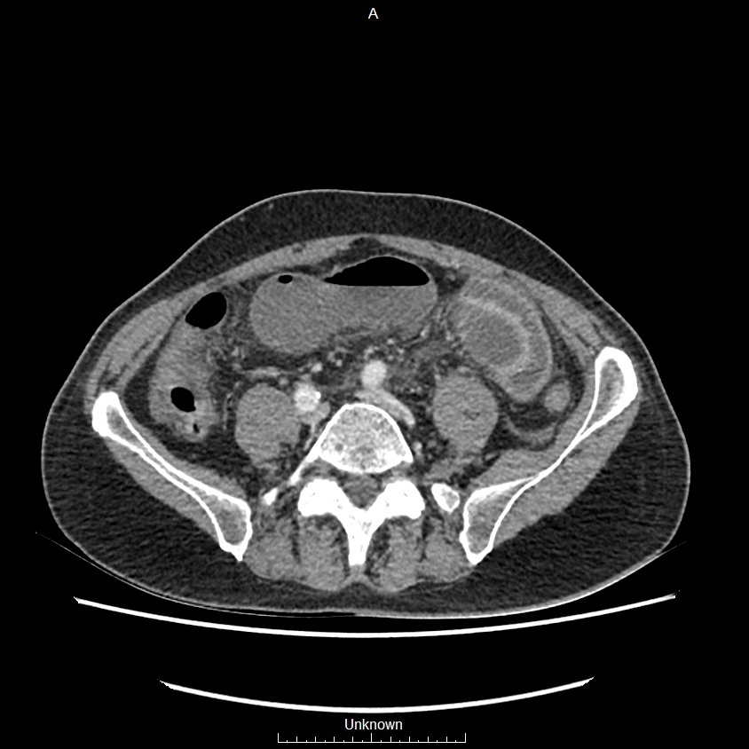 Closed loop bowel obstruction and ischemia (Radiopaedia 86959-103180 A 56).jpg