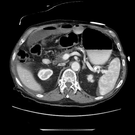Closed loop small bowel obstruction - adhesive disease and hemorrhagic ischemia (Radiopaedia 86831-102990 A 68).jpg