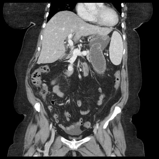 Closed loop small bowel obstruction - internal hernia (Radiopaedia 65402-74450 B 48).jpg