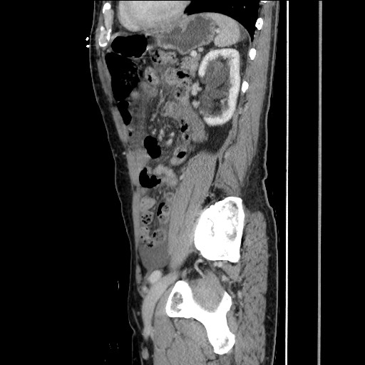 File:Closed loop small bowel obstruction - omental adhesion causing "internal hernia" (Radiopaedia 85129-100682 C 124).jpg