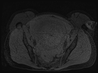 File:Closed loop small bowel obstruction in pregnancy (MRI) (Radiopaedia 87637-104031 G 1).jpg