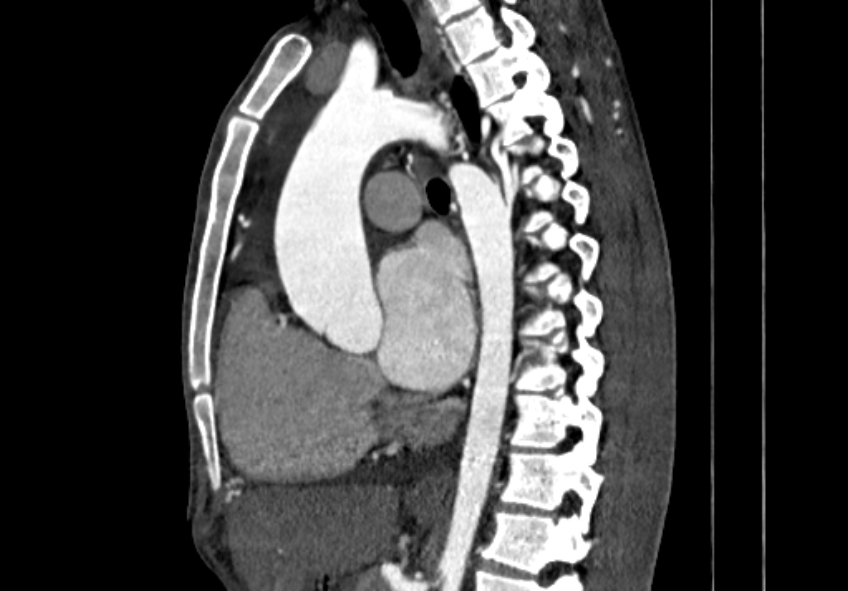 Coarctation of aorta with aortic valve stenosis (Radiopaedia 70463-80574 B 68).jpg