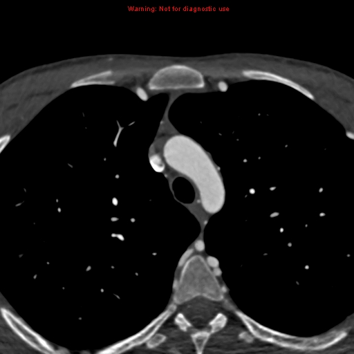 File:Coarctation of the aorta (Radiopaedia 12461-12697 A 53).jpg