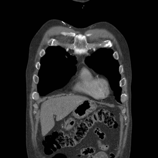 Coarctation of the aorta (Radiopaedia 17427-17116 A 72).jpg