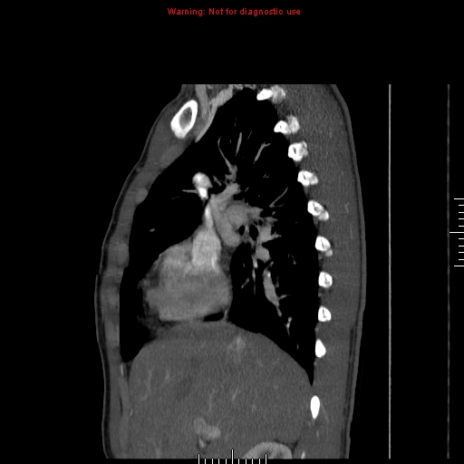 Coarctation of the aorta (Radiopaedia 9434-10118 B 15).jpg