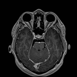 Cochlear incomplete partition type III associated with hypothalamic hamartoma (Radiopaedia 88756-105498 Axial T1 C+ 77).jpg