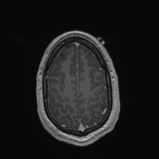 File:Colloid cyst (Radiopaedia 44510-48181 Axial T1 C+ 151).png