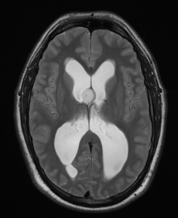 File:Colloid cyst (Radiopaedia 44510-48181 Axial T2 15).png