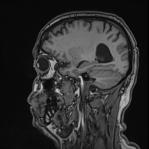 File:Colloid cyst of the third ventricle (Radiopaedia 86571-102662 Sagittal T1 54).png