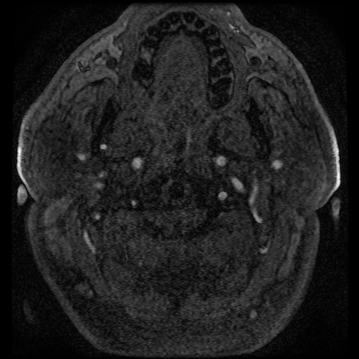 File:Colloid cyst with anterior communicating artery aneurysm (Radiopaedia 33901-35091 Axial MRA 8).jpg