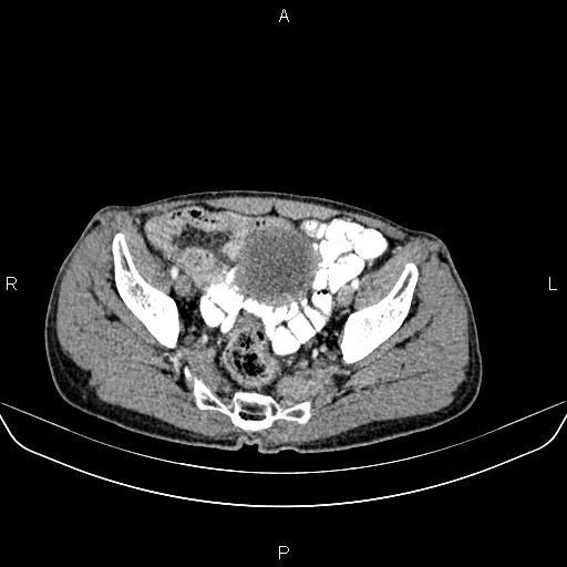 Colon adenocarcinoma - hepatic flexure (Radiopaedia 85635-101395 A 81).jpg