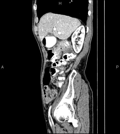 Colon adenocarcinoma - hepatic flexure (Radiopaedia 85635-101395 D 22).jpg