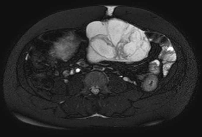 Colon adenocarcinoma with Krukenberg tumors, advanced pregnancy (Radiopaedia 67279-76645 Axial T2 SPAIR 38).jpg