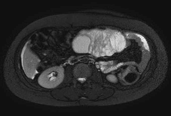 Colon adenocarcinoma with Krukenberg tumors, advanced pregnancy (Radiopaedia 67279-76645 Axial T2 SPAIR 46).jpg