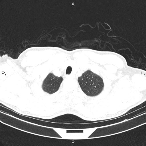 File:Colon cancer (Radiopaedia 85663-101443 Axial lung window 6).jpg