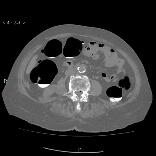 Colonic lipomas (Radiopaedia 49137-54244 Axial bone window 109).jpg