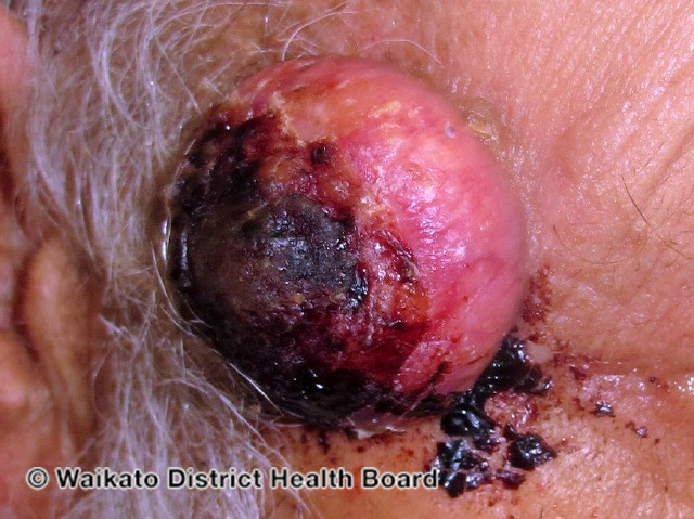 File:Crusted squamous cell carcinoma (DermNet NZ bleeding-02).jpg