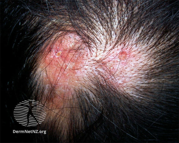 Cutaneous lupus erythematosus (DermNet NZ immune-lupus-erythematosus-2561).jpg