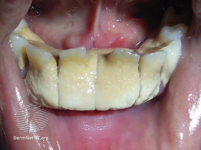 File:Dental plaque (DermNet NZ bacterial-dental-plaque).jpg