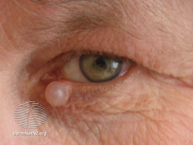 File:More images of hidrocystoma of the eyelid. (DermNet NZ hidrocystoma-02).jpg