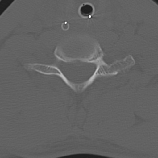 File:Multitrauma with diffuse axonal injury, temporal bone fractures and traumatic caroticocavernous fistula (Radiopaedia 37242-39035 Axial 188).png
