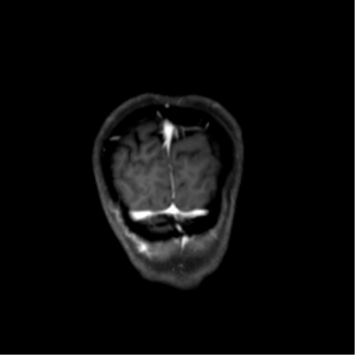 File:Nasopharyngeal carcinoma with cerebral abscess (Radiopaedia 43018-46274 L 51).png