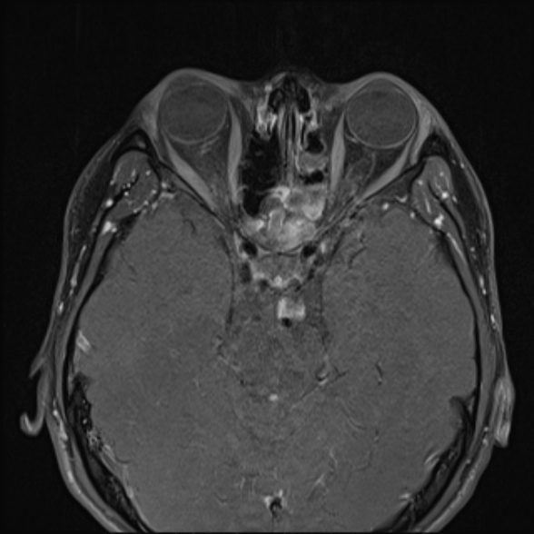 Nasopharyngeal carcinoma with skull base invasion (Radiopaedia 53415-59485 Axial T1 C+ fat sat 16).jpg