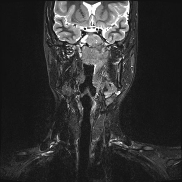Nasopharyngeal carcinoma with skull base invasion (Radiopaedia 53415-59485 Coronal T2 fat sat 21).jpg