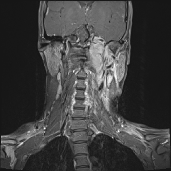Nasopharyngeal carcinoma with skull base invasion (Radiopaedia 53415-59485 E 15).jpg