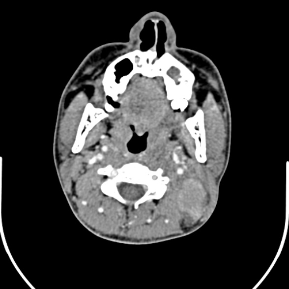 Nasopharyngeal carcinoma with skull base invasion (Radiopaedia 53415-59705 A 86).jpg