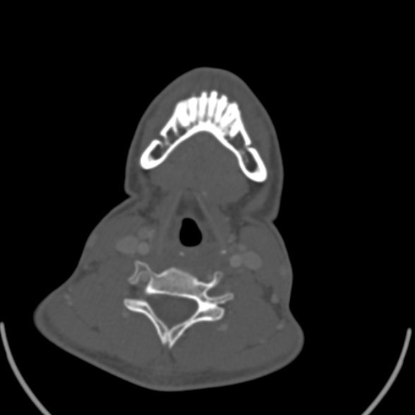 Nasopharyngeal carcinoma with skull base invasion (Radiopaedia 53415-59705 Axial bone window 142).jpg
