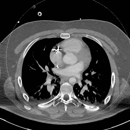 Neck CT angiogram (intraosseous vascular access) (Radiopaedia 55481-61945 B 5).jpg