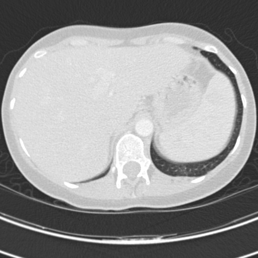 Necrobiotic pulmonary nodules - Crohn disease (Radiopaedia 20723-20631 Axial lung window 132).jpg