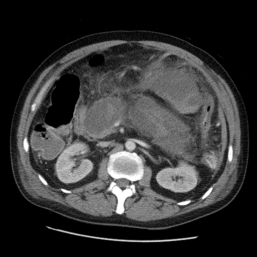 File:Necrotizing pancreatitis - acute necrotic collection maturing into walled-off pancreatic necrosis (Radiopaedia 9602-36947 A 9).jpg